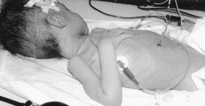 photo of child demonstrating failure to thrive